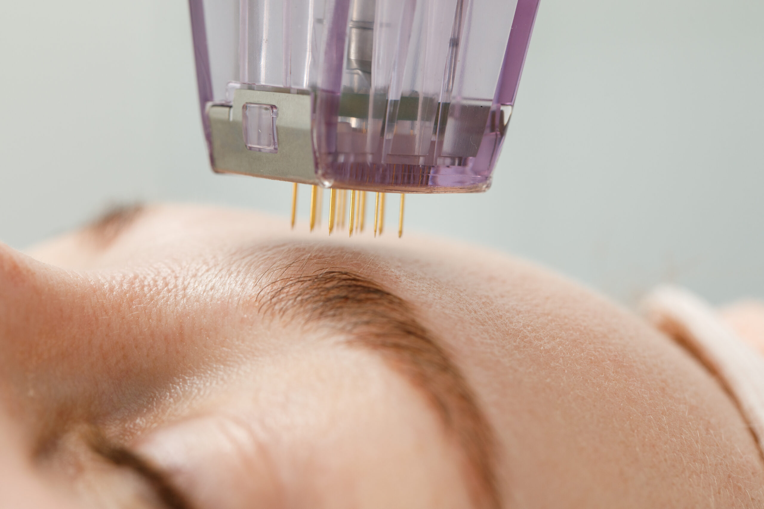 Microneedle mesotherapy. Woman receiving micro needling rejuvenation treatment in a cosmetology clinic