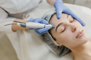 Microneedling treatment at The Wellness at Ridgewood